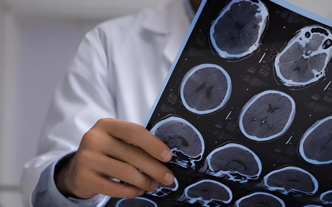 Valor del Acuerdo por Síndrome Postconmoción Cerebral